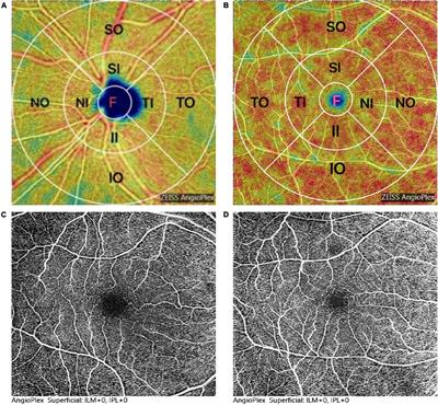 Retinal Microvascular Density Was Associated With the Clinical Progression of Parkinson’s Disease